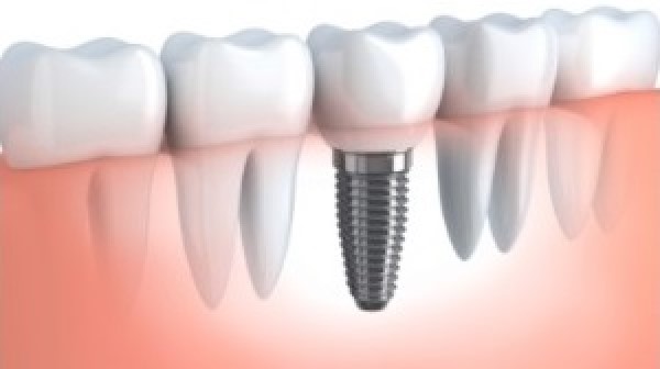 Dental Implants