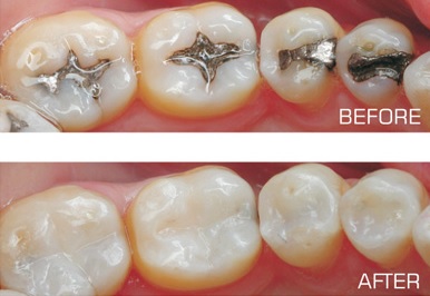 Amalgam-Free Dentistry