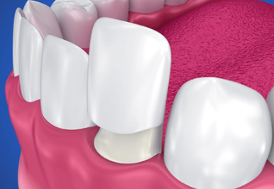 Dental Crowns and Bridges