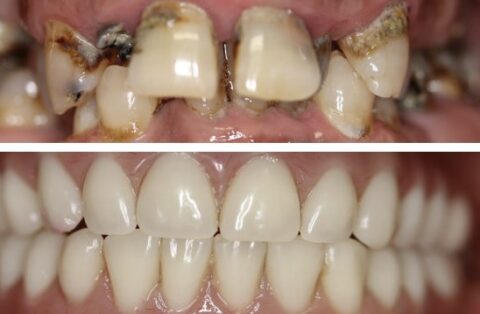 Full Mouth Reconstructions