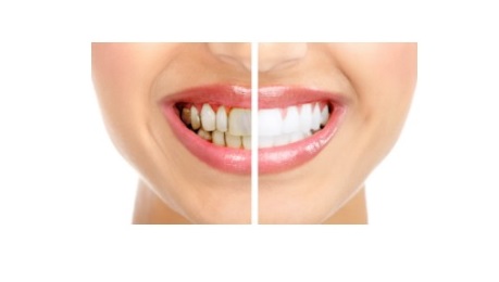 Dental Veneers